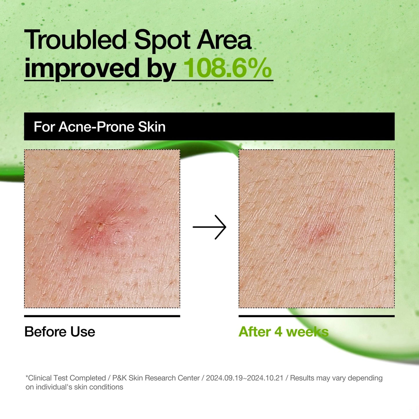 Azelaic Acid 10 Hyaluron Redness Soothing Serum - Lumiso